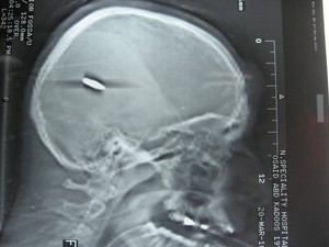 צילום רנטגן של הקליע בראשו של קדוס. צילום: סלמה דבעי, בצלם