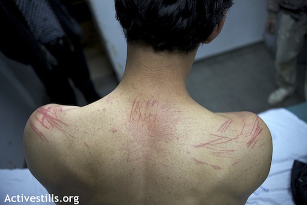 גבו של אחד ממארגני הפגנה פלסטינית לאחר שחרורו ממעצר וחקירה בכלא הישראלי ב-2010. (אקטיבסטילס)