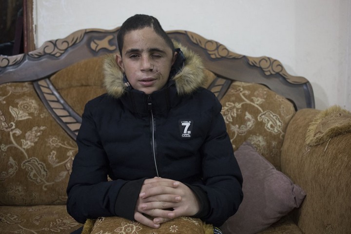 מוחמד תמימי בן ה-15 שנפצע כשבועיים לפני כן בראשו מירי של הצבא הגיע גם הוא לחזק. נבי סאלח, 5 בינואר 2018 (אורן זיו / אקטיבסטילס) 