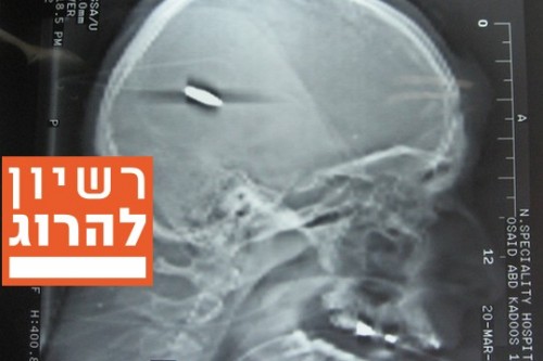 צילום רנטגן של ראשו של אסוייד קאדוס מבית החולים בשכם. לא כדור גומי. מתוך תיק החקירה
