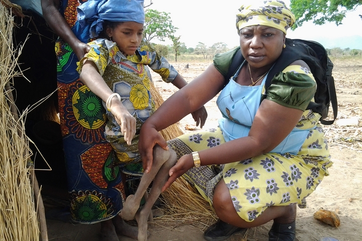 ילדה חולת פוליו בניגריה ב-2014 (צילום: CDC Global, CC BY 2.0)