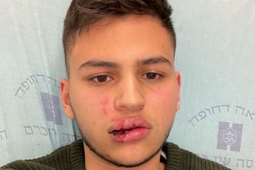 בשאר מסאלחה, בבית החולים הדסה עין כרם אחרי התקיפה (צילום: באדיבות המצולם) בשאר מסאלחה, בבית החולים הדסה עין כרם אחרי התקיפה (צילום: באדיבות המצולם)