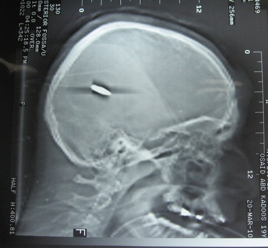 צילום רנטגן של גולגלתו של אוסייד קאדוס